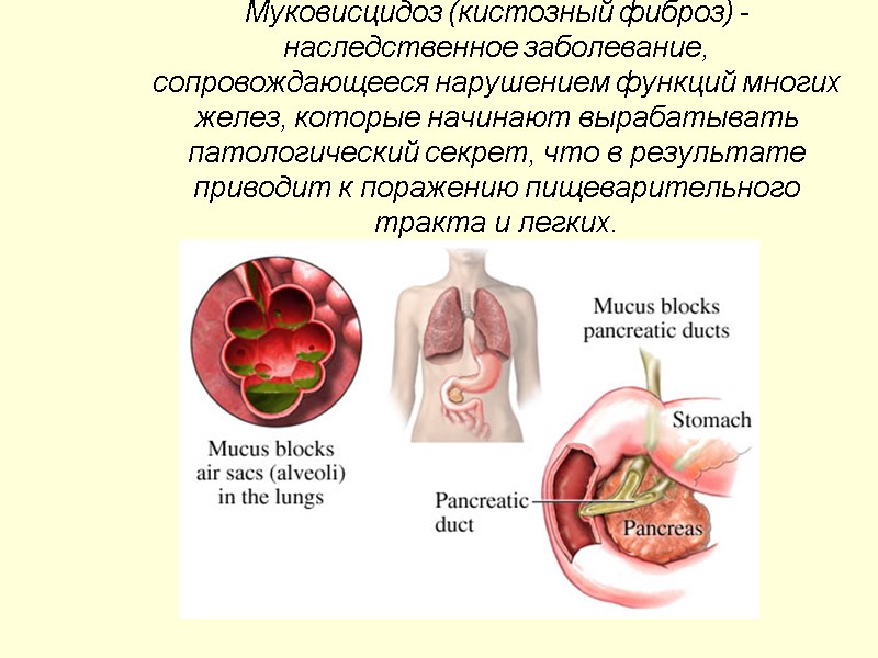 Муковисцидоз (кистозный фиброз) - наследственное заболевание, сопровождающееся нарушением функций многих желез, которые начинают вырабатывать